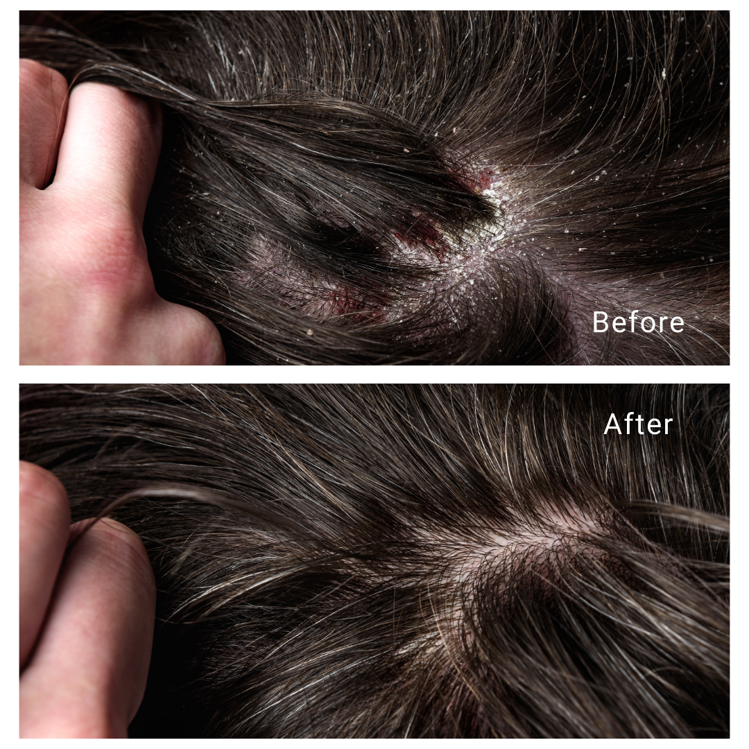 Atasi-Dermatitis-Seboroik-Dalam-3x-Keramas-5.png
